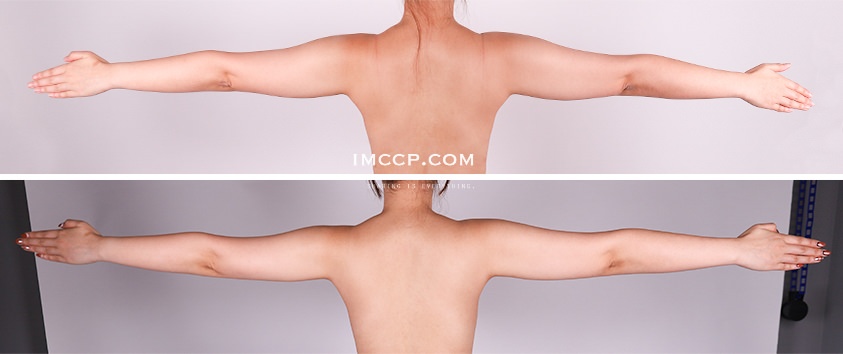 (文長圖多)手臂+C型副乳顯微套管抽脂全紀錄/ 自體脂肪移植補胸 @麗波永康國際診所